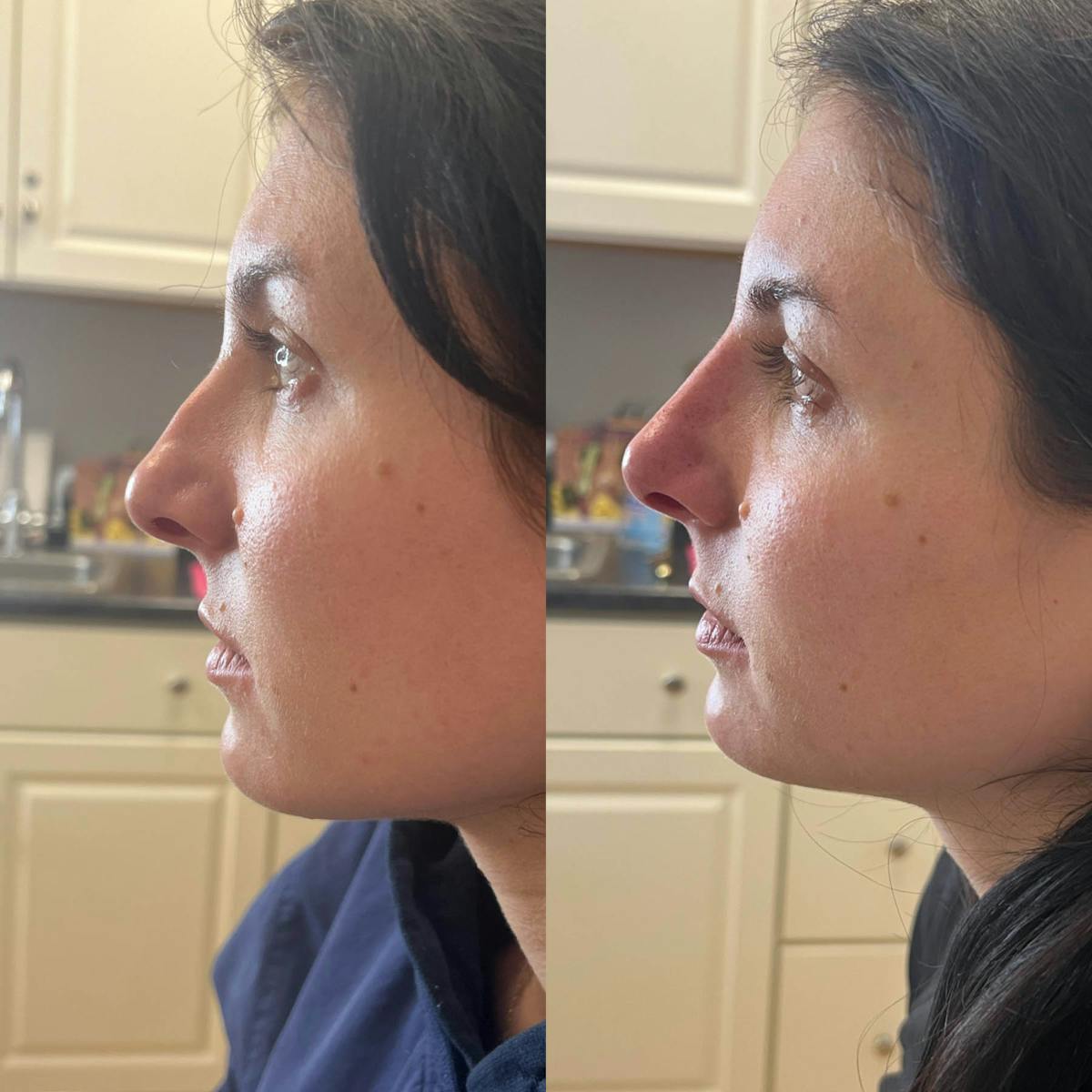 Liquid Rhinoplasty Before & After Gallery - Patient 256658 - Image 1