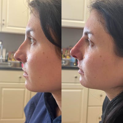 Liquid Rhinoplasty Before & After Gallery - Patient 256658 - Image 1