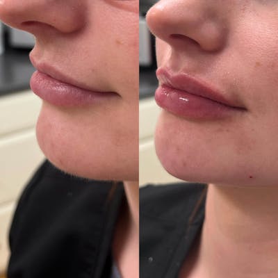 Lips Before & After Gallery - Patient 296678 - Image 1