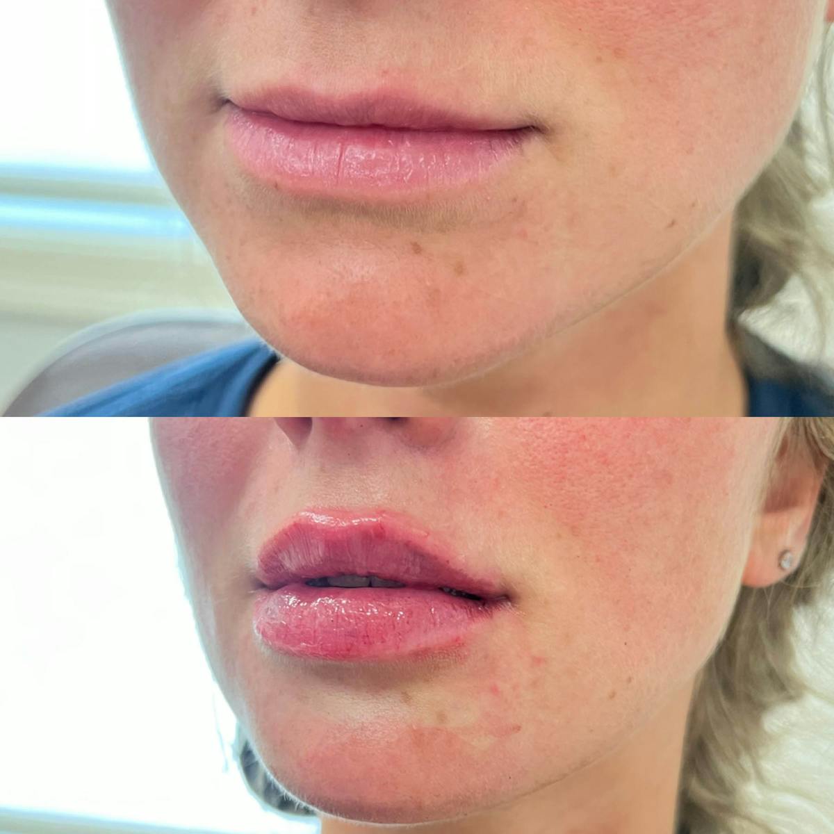 Lips Before & After Gallery - Patient 116824 - Image 1