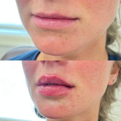 Lips Before & After Gallery - Patient 116824 - Image 1