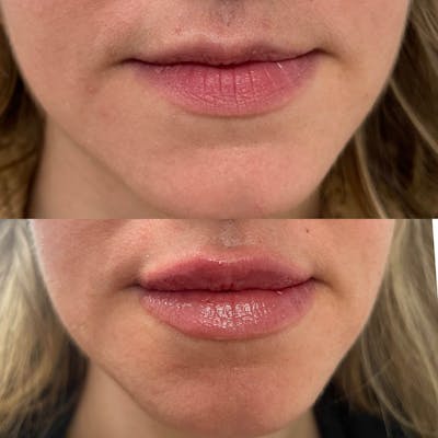Lips Before & After Gallery - Patient 207310 - Image 1