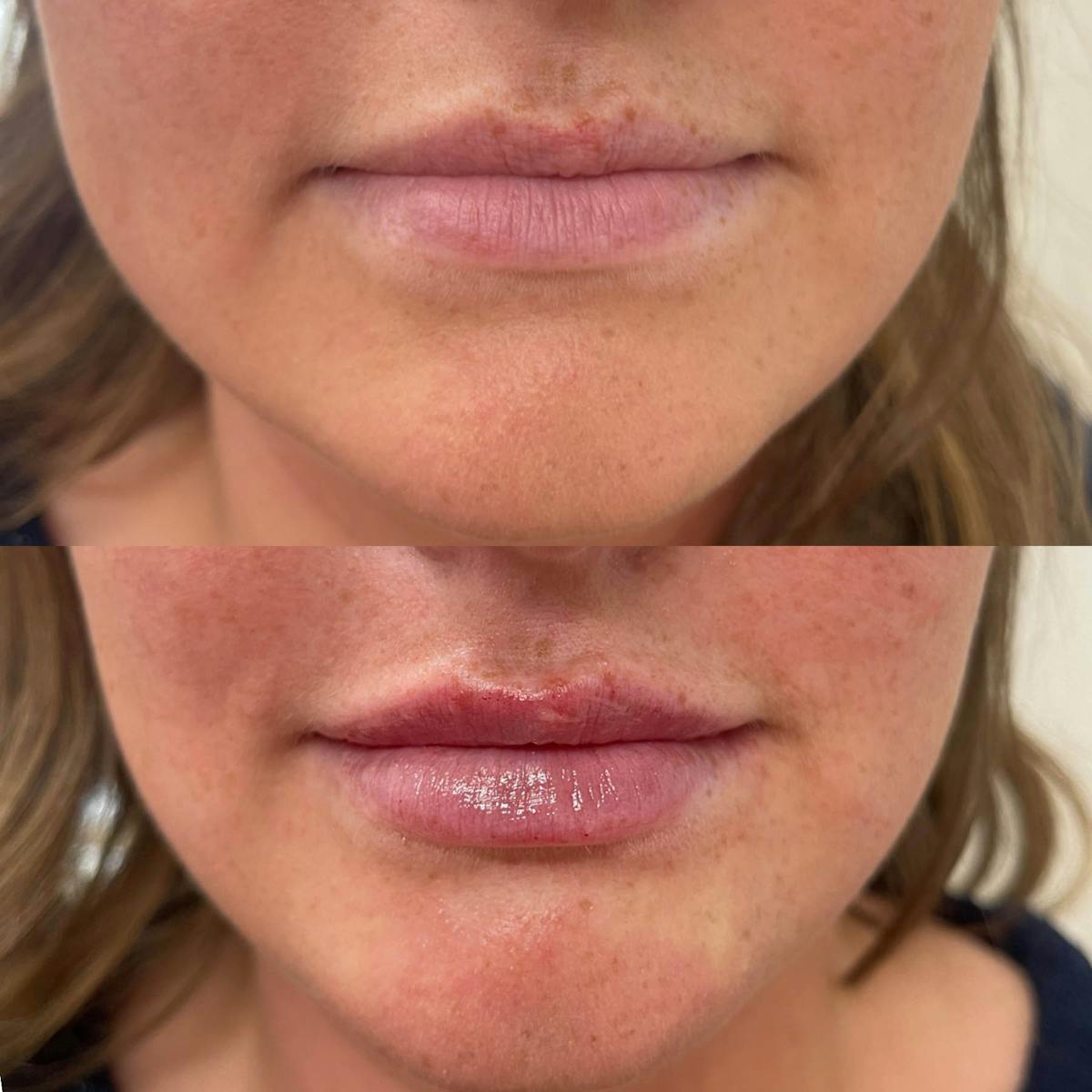 Lips Before & After Gallery - Patient 226144 - Image 1