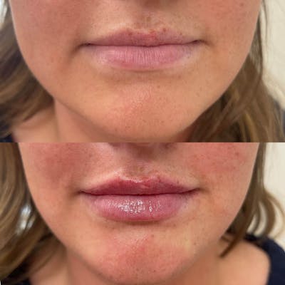 Lips Before & After Gallery - Patient 226144 - Image 1