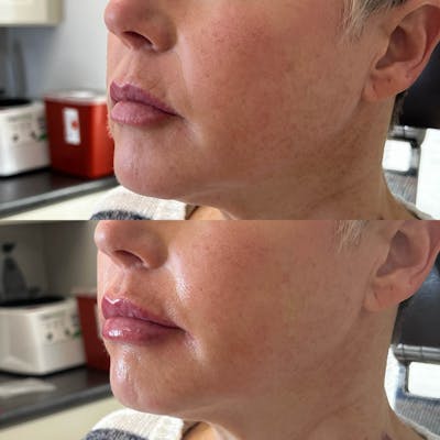 Lips Before & After Gallery - Patient 126940 - Image 1