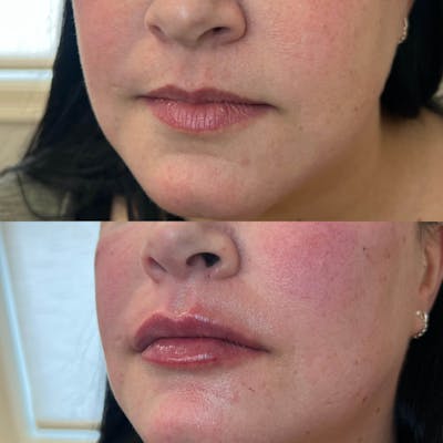 Lips Before & After Gallery - Patient 341786 - Image 1
