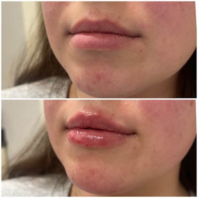 Lips Before & After Gallery - Patient 309190 - Image 1
