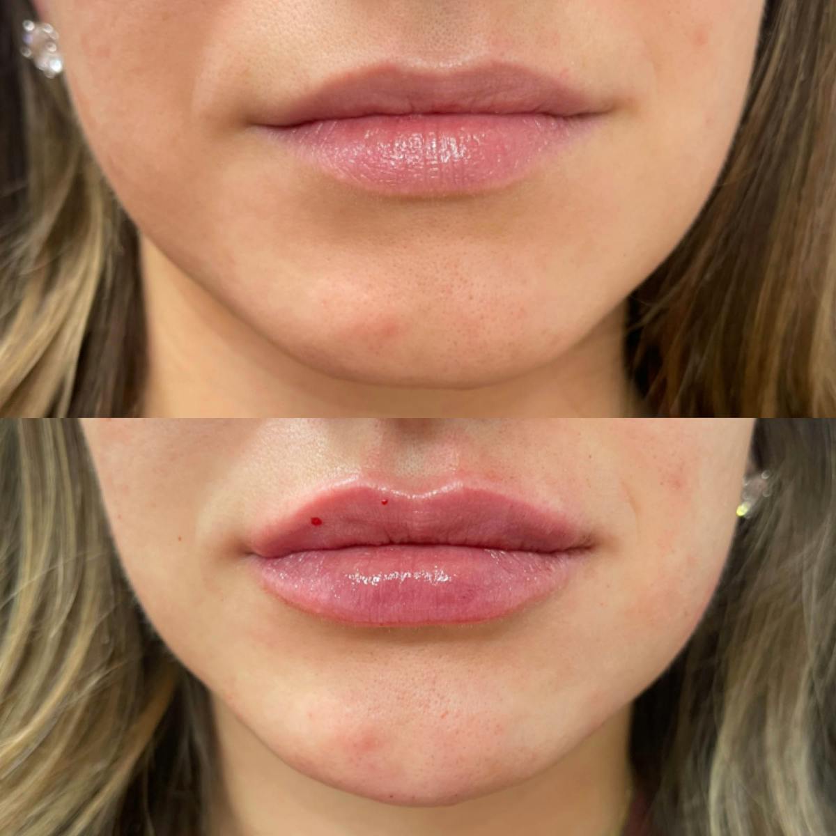 Lips Before & After Gallery - Patient 102889 - Image 1