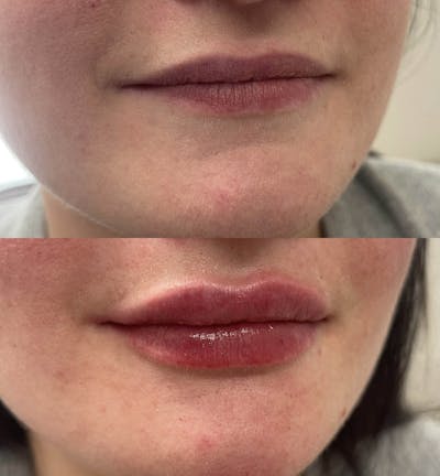 Lips Before & After Gallery - Patient 364474 - Image 1