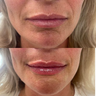 Lips Before & After Gallery - Patient 340827 - Image 1