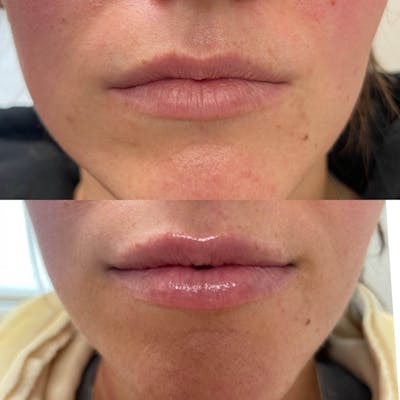Lips Before & After Gallery - Patient 339168 - Image 1