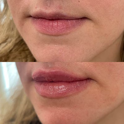 Lips Before & After Gallery - Patient 913835 - Image 1
