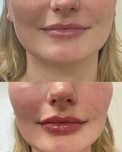 Lips Before & After Gallery - Patient 307339 - Image 1