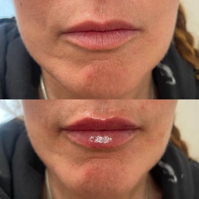 Lips Before & After Gallery - Patient 362458 - Image 1