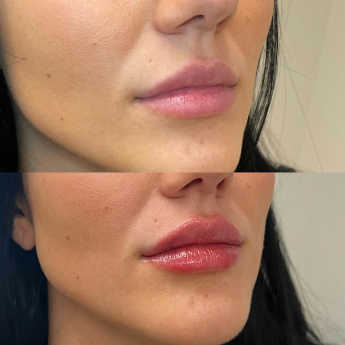 Lips Before & After Gallery - Patient 425702 - Image 1