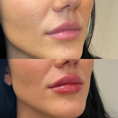 Lips Before & After Gallery - Patient 425702 - Image 1