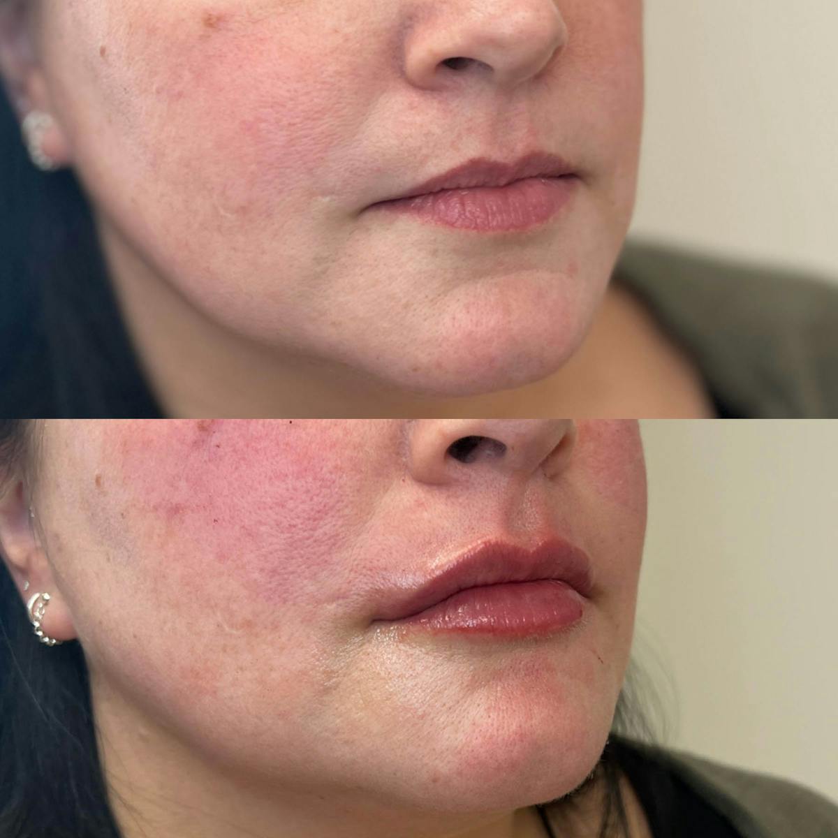 Lips Before & After Gallery - Patient 343446 - Image 1