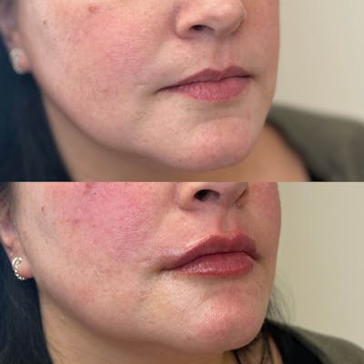 Lips Before & After Gallery - Patient 343446 - Image 1