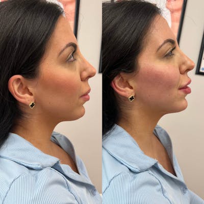 Jaw + Cheek Filler Before & After Gallery - Patient 331208 - Image 1