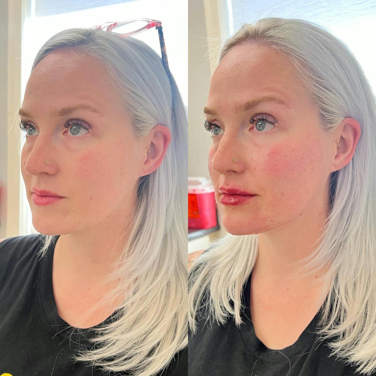 Jaw + Cheek Filler Before & After Gallery - Patient 143954 - Image 1