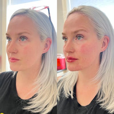 Jaw + Cheek Filler Before & After Gallery - Patient 143954 - Image 1