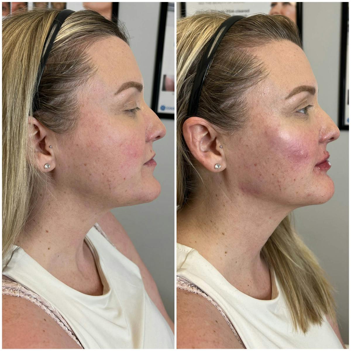 Jaw + Cheek Filler Before & After Gallery - Patient 495438 - Image 1