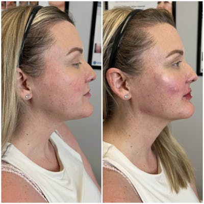 Jaw + Cheek Filler Before & After Gallery - Patient 495438 - Image 1