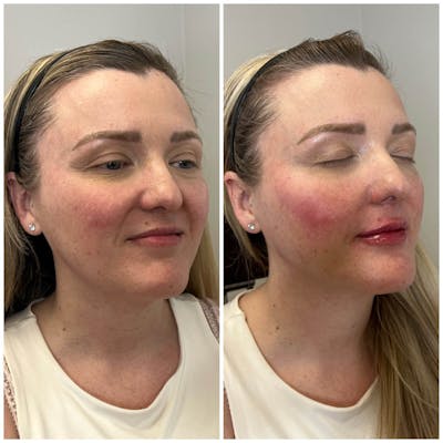 Jaw + Cheek Filler Before & After Gallery - Patient 367859 - Image 1