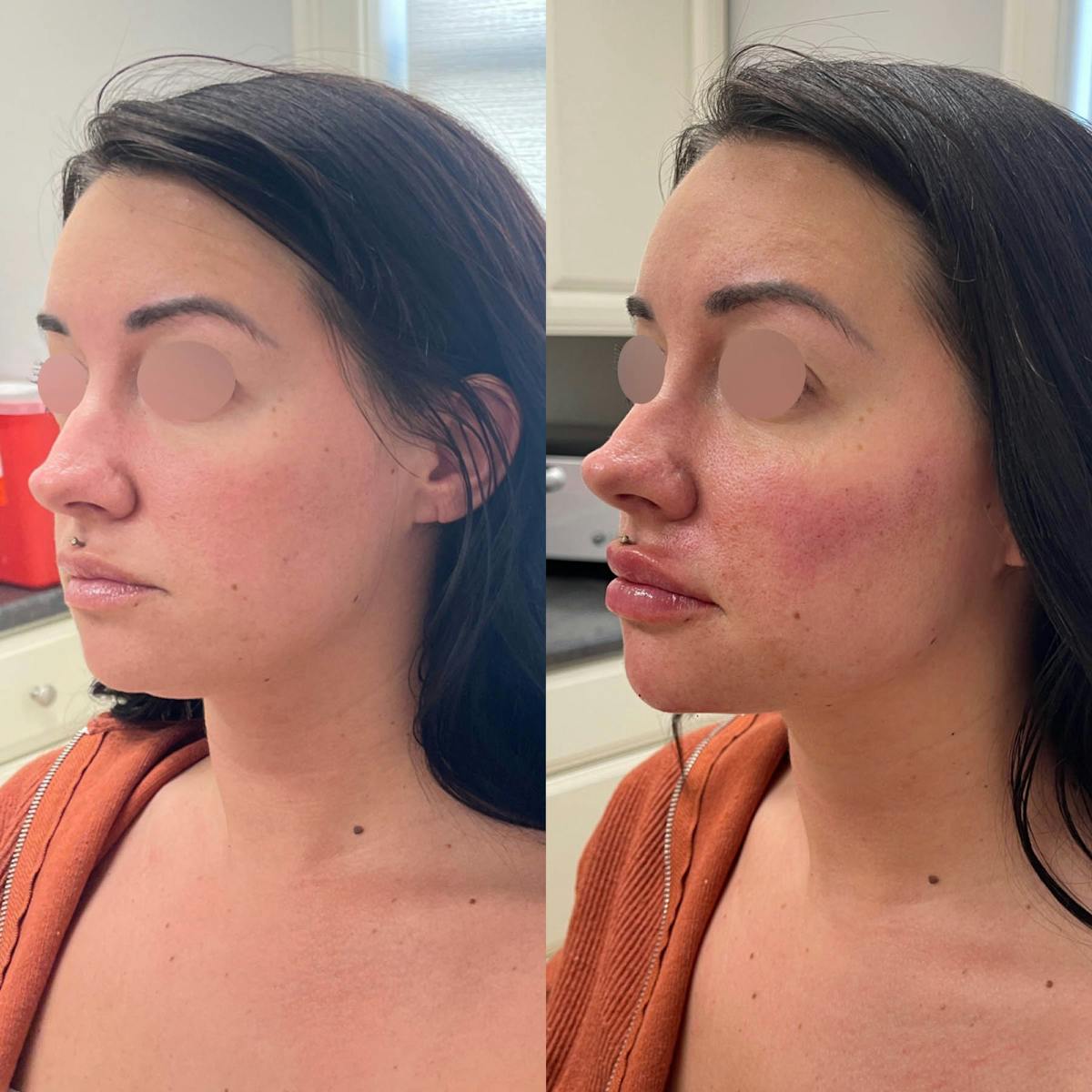 Jaw + Cheek Filler Before & After Gallery - Patient 218061 - Image 1