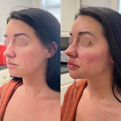 Jaw + Cheek Filler Before & After Gallery - Patient 218061 - Image 1
