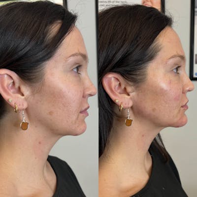 Jaw + Cheek Filler Before & After Gallery - Patient 245655 - Image 1