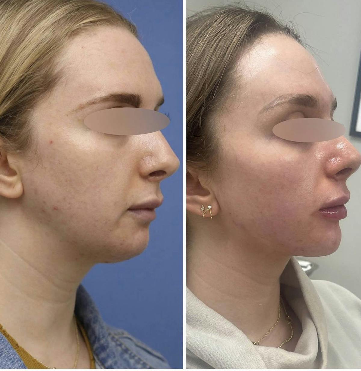 Jaw + Cheek Filler Before & After Gallery - Patient 165194 - Image 1
