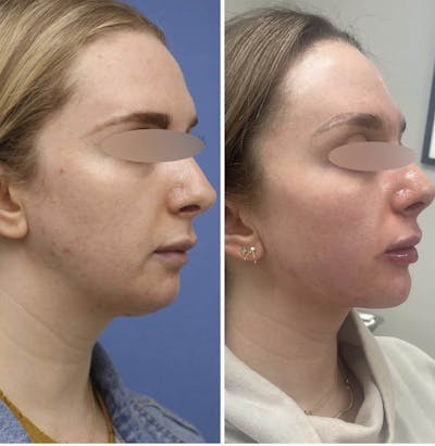 Jaw + Cheek Filler Before & After Gallery - Patient 165194 - Image 1
