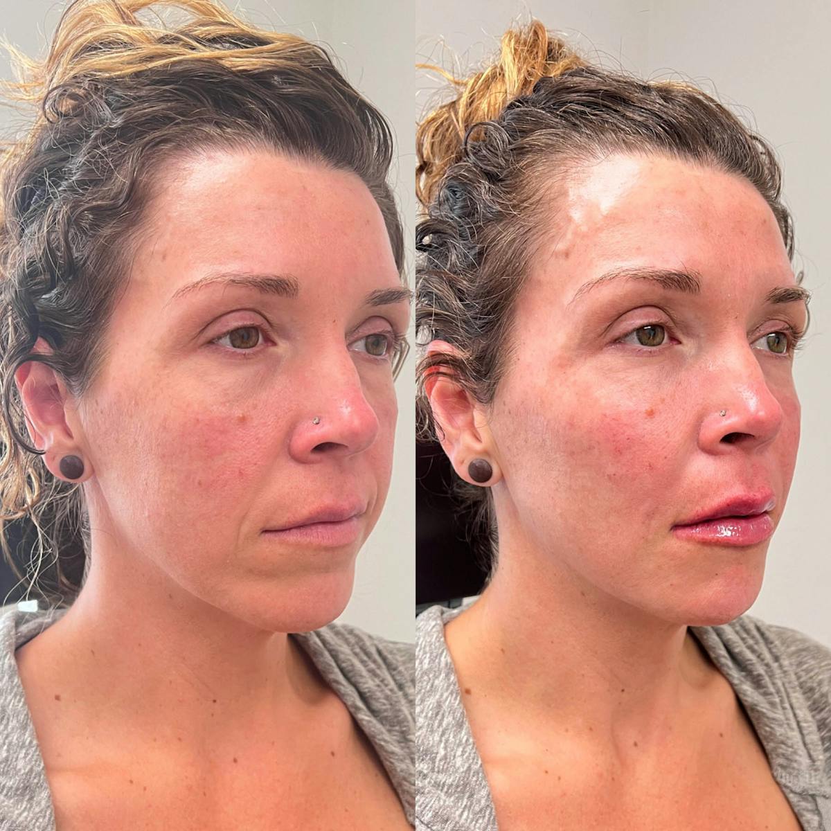 Jaw + Cheek Filler Before & After Gallery - Patient 116412 - Image 1