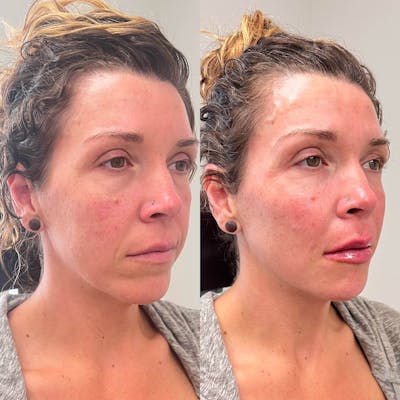 Jaw + Cheek Filler Before & After Gallery - Patient 116412 - Image 1