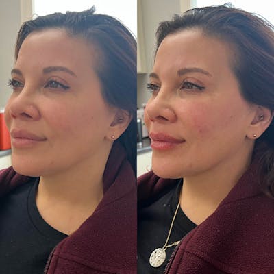 Jaw + Cheek Filler Before & After Gallery - Patient 310791 - Image 1
