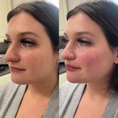 Jaw + Cheek Filler Before & After Gallery - Patient 391250 - Image 1