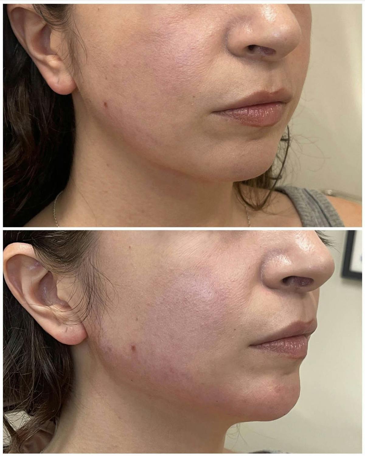 Jaw + Cheek Filler Before & After Gallery - Patient 183344 - Image 1