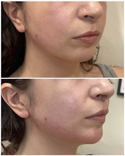 Jaw + Cheek Filler Before & After Gallery - Patient 183344 - Image 1