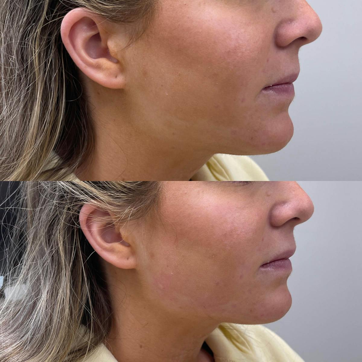 Jaw + Cheek Filler Before & After Gallery - Patient 191567 - Image 1