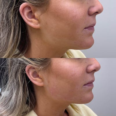 Jaw + Cheek Filler Before & After Gallery - Patient 191567 - Image 1