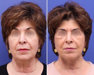 Face Before & After Gallery - Patient 406574 - Image 1