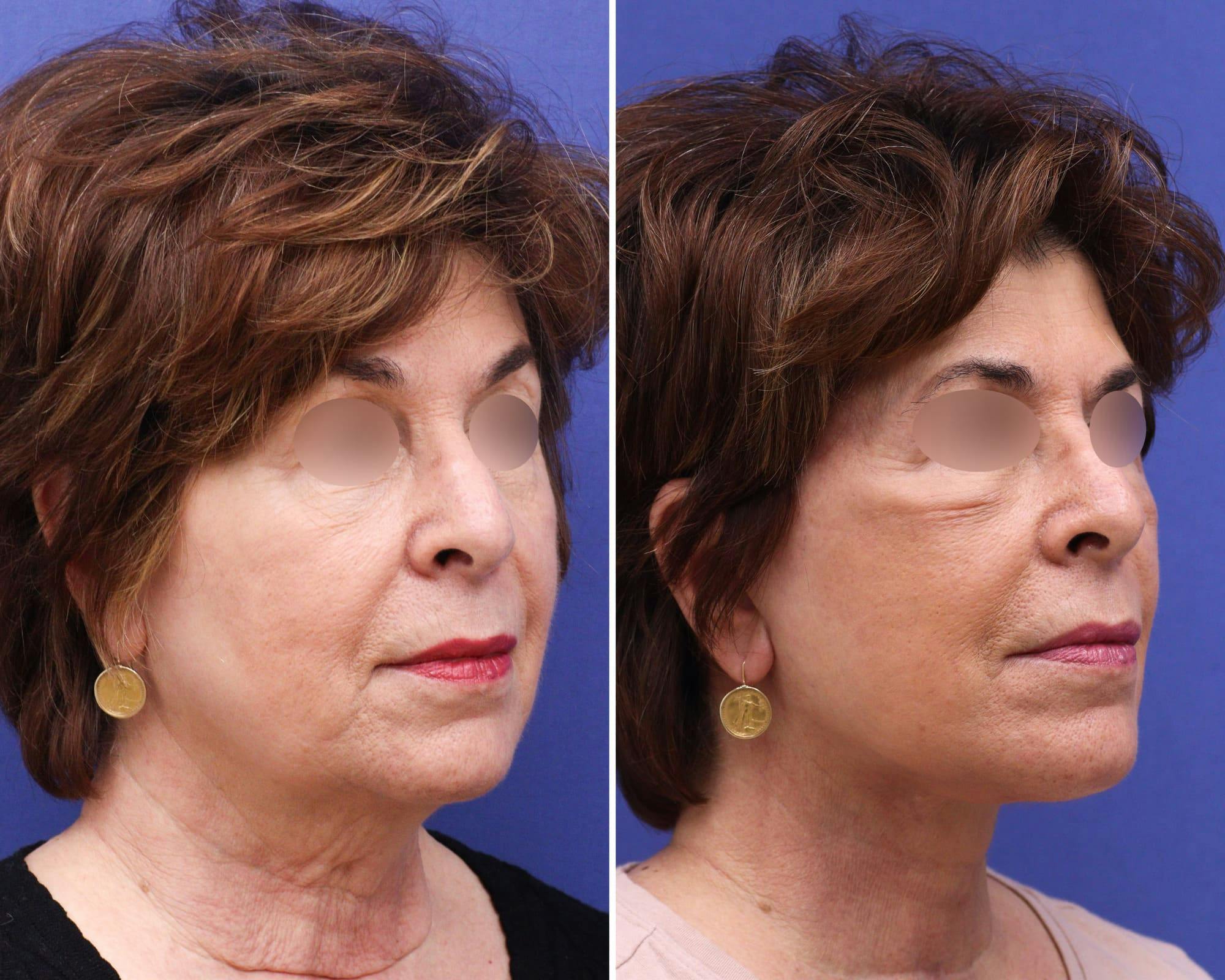 Buccal Fat Removal Before & After Gallery - Patient 205439 - Image 2