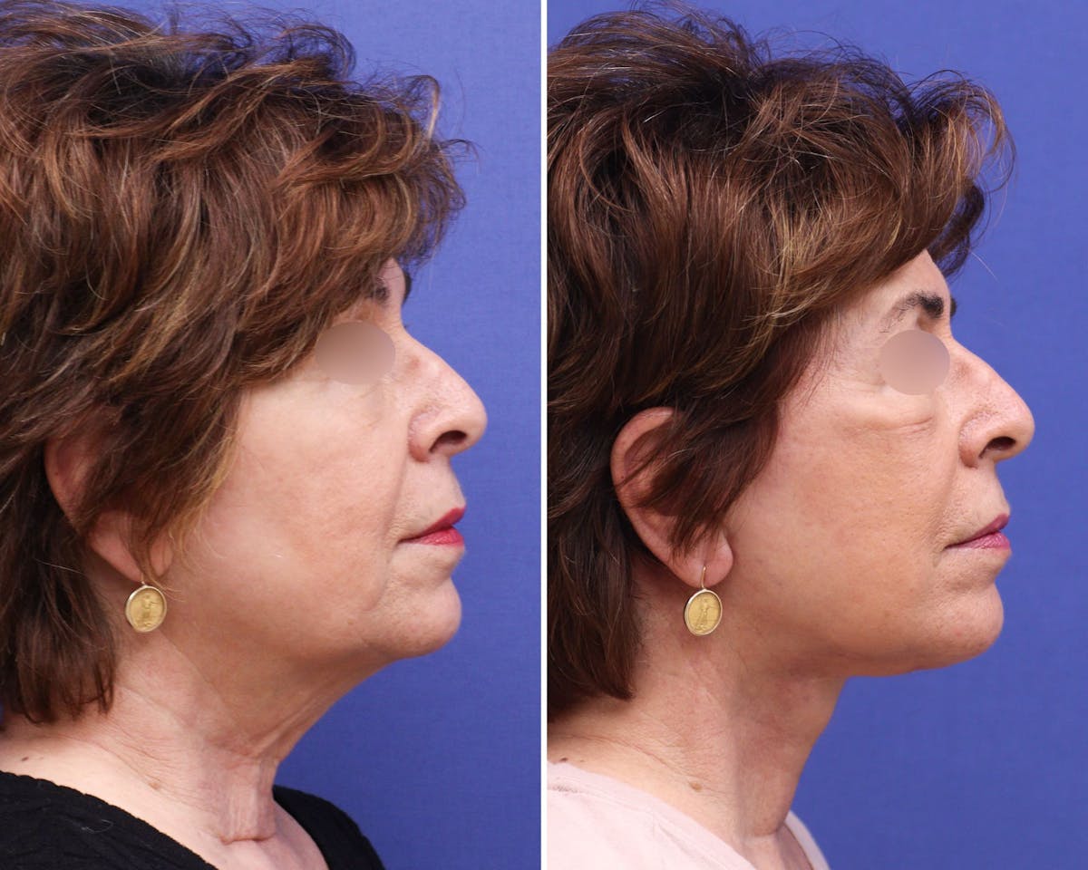 Face Before & After Gallery - Patient 406574 - Image 3