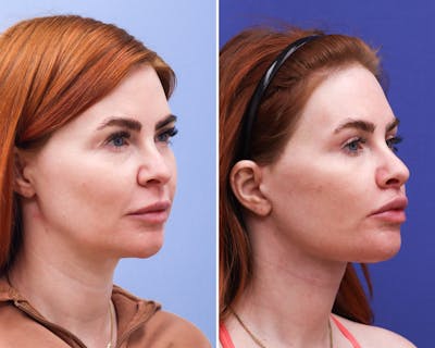 Facelift Before & After Gallery - Patient 840176 - Image 1