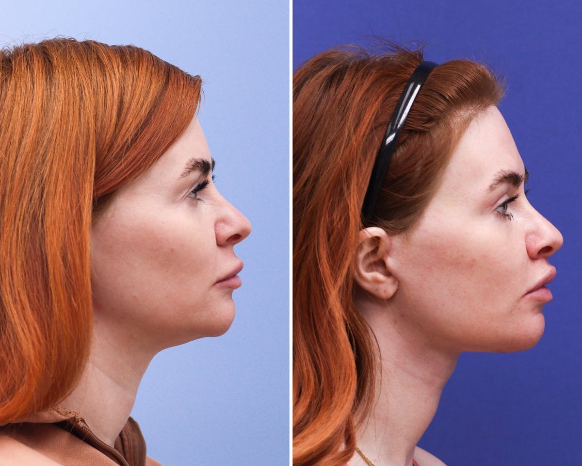 Facelift Before & After Gallery - Patient 840176 - Image 2