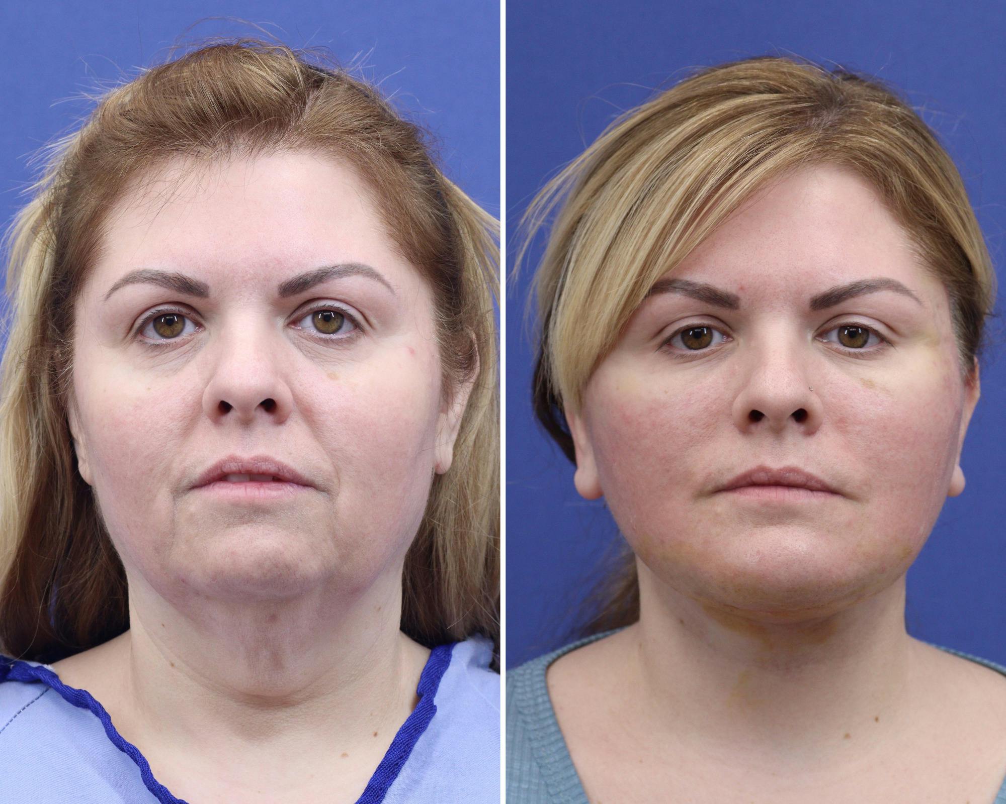 Face Before & After Gallery - Patient 346275 - Image 1