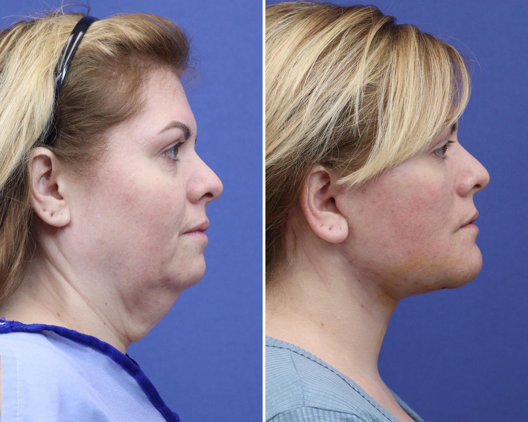 Face Before & After Gallery - Patient 346275 - Image 3