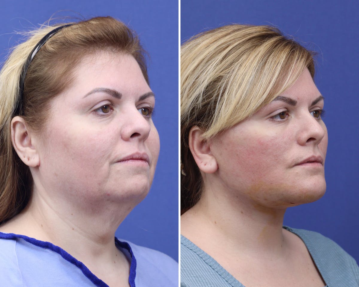 Face Before & After Gallery - Patient 346275 - Image 2