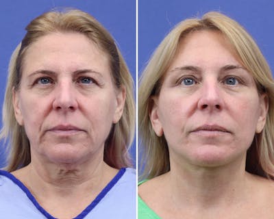 Facelift Before & After Gallery - Patient 382796 - Image 1